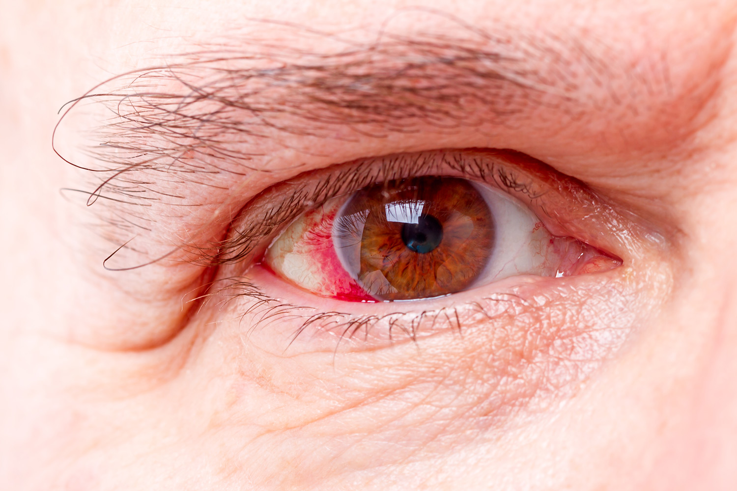 eye-irritation-abrasion-or-pink-eye-when-to-see-an-eye-doctor-mayo